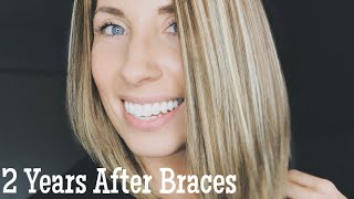 “POST BRACES”  2 Years Later  Life Update [upl. by Odlaniger62]