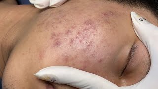 ACNE TREATMENT VU QUYNH MI Acne On Boys Cheek 2024 [upl. by Sands]