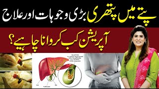 Gallstones Causes and Treatment  Dr Fareeha Tariq [upl. by Olim]