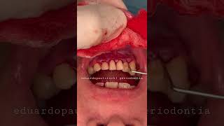 Periodontite após raspagem subgengival observe a situação dessa gengiva no final periodontia [upl. by Sebbie]