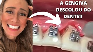 Isso acontece em quem não escova os dentes 😰 dravanessagualda aparelhoortodôntico higiene [upl. by Trawets]