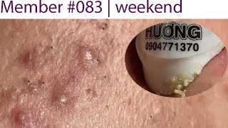 Acne Treatment Huong Da Nang 083  Member [upl. by Celeski120]