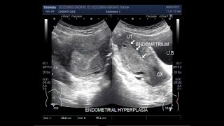 Endometrial Hyperplasia in Patient aged 45 years [upl. by Ahtram584]