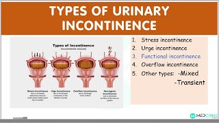 Types of Urinary Incontinence EXPLAINED Stress urge functional overflow incontinence [upl. by Tudela]