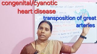 cyanotic heart disease transposition of great arteries [upl. by Neveda792]