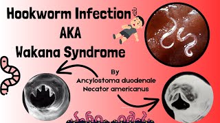 Hookworm Causes Signs and Symptoms Diagnosis and Treatment  Intestinal Nematodes  Novice Medic [upl. by Nysilla368]