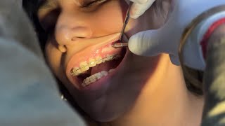 Orthodontic implant placement [upl. by Eatnoled49]