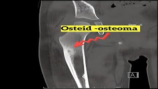 Osteoid Osteoma Insights [upl. by Ileray]