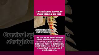 Cervical spine curvature straightening processcervical spine subscribe like shortvideo [upl. by Weidman587]