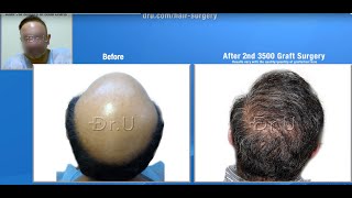 A Hair Transplant Solution for Complete Baldness Permanent Credible Results  Dr U [upl. by Neret361]