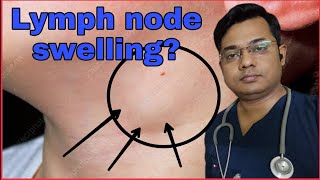 Causes of lymph node swelling and treatmentLymphomaDoctor on YouTube glandswelling [upl. by Cord311]