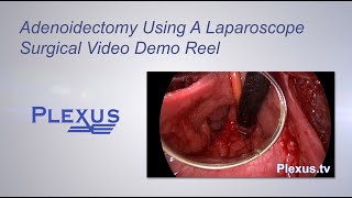 Adenoidectomy Surgical Video [upl. by Lamprey]