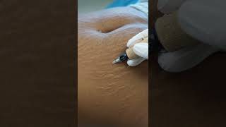 Stretch Marks Inkless Removal Boleyn Treatment Los Angeles 🌍 shorts [upl. by Assili822]