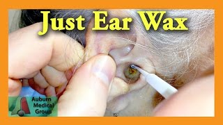 Ear Wax Removal Doctor  Auburn Medical Group [upl. by Aicelet351]