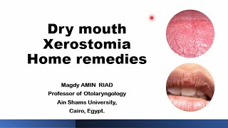 Home remedies for Dry mouth Xerostomia [upl. by Oiled896]