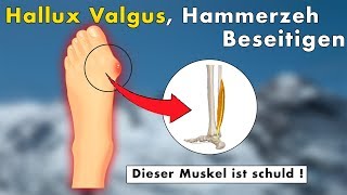 3 Übungen gegen Hallux Valgus Hammerzeh Ballenzeh  Die WAHRE Ursache amp Lösung [upl. by Thin]