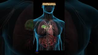 Learn about possible complications from Pneumonia  pneumonia medical video [upl. by Yehs]