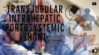 Transjugular Intrahepatic Portosystemic Shunt  TIPS procedure What is It [upl. by Yerffeg]