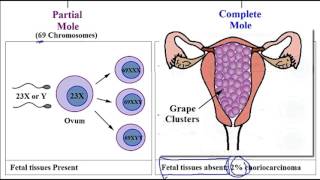 Video 254 Hydatidiform Mole Molar Pregnancy Partial vs Complete Mole amp Associated Risk Factors [upl. by Yllah840]