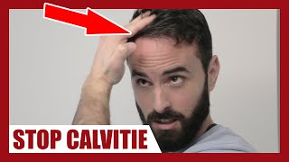 CALVITIE  Comment appliquer correctement le MINOXIDIL afin de la stopper [upl. by Cadal]