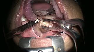 COBLATION ASSISTED TONSILLECTOMY IN A CHILD [upl. by Dedie]