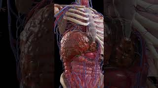 Cirrhosis Liver Under Siege 3dmodel meded anatomy [upl. by Nospmoht]