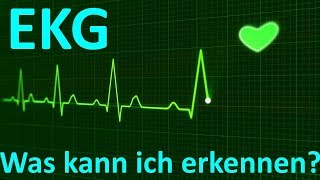 Was erkennt man beim EKG Monitoring 3Kanal [upl. by Jerold]