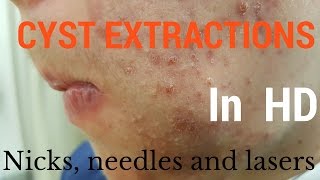 Cysts extractions blackheads  Removal methods in HD [upl. by Tace249]