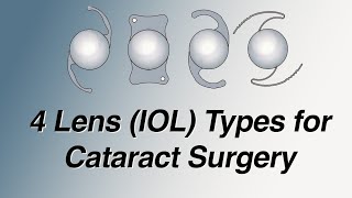 4 Main Lens IOL Types for Cataract Surgery Pros and Cons Basic Version [upl. by Bartholomew447]