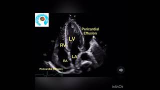 Pericardial Effusion on Cardiac Ultrasound POCUS [upl. by Tnilc]