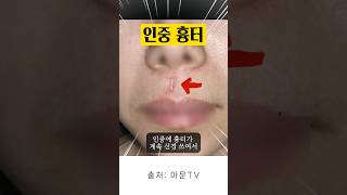 흉터 제거 수술 후기 치료 병원 비후성반흔 켈로이드 주사 서울 치료 face scar surgery hypertrophic scar keloid seoul korea아문TV [upl. by Fredella198]