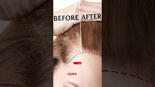 Minoxidil 1052 Mintop  Hair lossHair ReGrowBaldness Doctor Meds Uses In HindiampEngSub [upl. by Worthy]