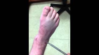 Video of Foot Motion after Arthroscopic Ankle Fusion SFISM [upl. by Etteniotna]