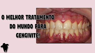 Gengiva Inflamada e Sangrando DESCUBRA Qual o Melhor Tratamento Caseiro DO MUNDO Para Gengivite [upl. by Oika408]