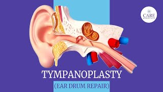 Eardrum Hole Repair Tympanoplasty  How it is done  After Tympanoplasty Care  CARE Hospitals [upl. by Zailer]