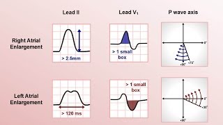 Intro to EKG Interpretation  Chamber Enlargement [upl. by Stephannie]