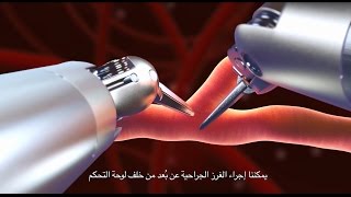 Totally Endoscopic Robotic Coronary Bypass TECAB [upl. by Nnoryt759]