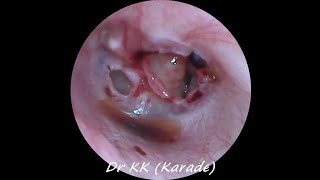 Double Traumatic Tympanic Membrane  Eardrum  Perforation [upl. by Ahseuqram396]