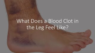 What Does a Blood Clot in the Leg Feel Like [upl. by Lovato]