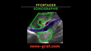 Sonografie  Pfortader [upl. by Ettelimay]