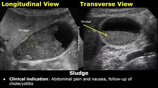 Gallbladder Ultrasound Reporting  GB Disease Scan Reports  How To Write USG Report  Abdominal USG [upl. by Nemra]