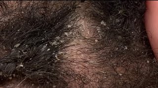 Dandruff Picking and Scratching  Flaky Eczema Scalp extreme close up ASMR [upl. by Ariane]