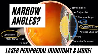 Narrow Angles Does a Laser Peripheral Iridotomy LPI Work [upl. by Ahsetel746]