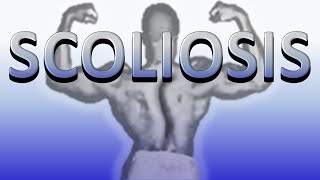 Scoliosis Kyphosis Postop Training Sully vs The Lymphoma [upl. by Corri394]