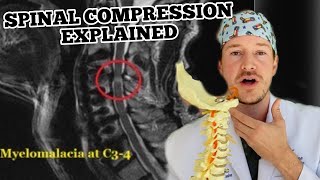 Spinal Cord Compression [upl. by Emilie]