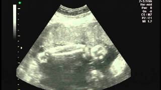 Ultrasound scan at 33 week pregnancy [upl. by Ynohtnael573]