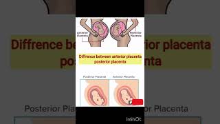 Difference between anterior placenta posterior placenta  anterior  posterior [upl. by Nostaw]