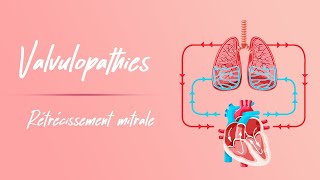 Rétrécissement mitral  Physiopathologie [upl. by Aneehta]