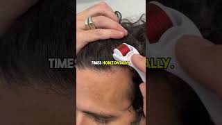 How to use the Derma Roller for Hair Loss [upl. by Ecirtak]