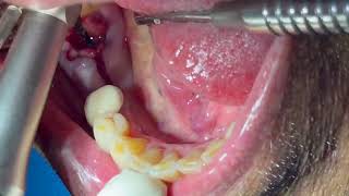 Immediate Post Extraction Placement in the Mandibular Molar Area [upl. by Eshman]